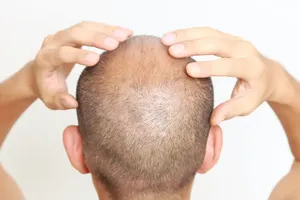 hair loss medications side effects