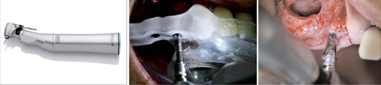 Preparation using system burs Preparation using system burs