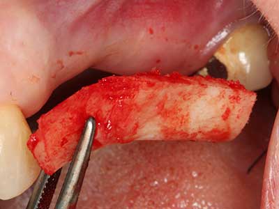 Piezosurgery Piezosurgery