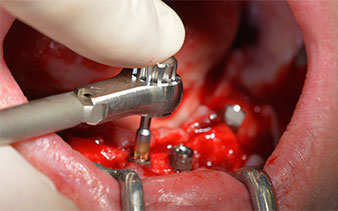 Implants Implants