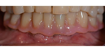 Implantes Implantes