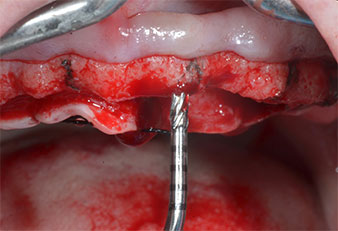 Инструменти I2A/I2P за Piezomed Инструменти I2A/I2P за Piezomed
