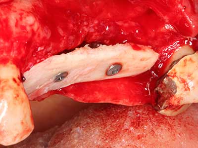 Piezosurgery Piezosurgery