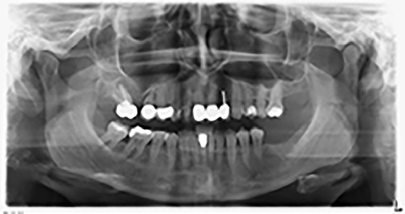 Ортопантомография с костна атрофия в зони 16–14.  Ортопантомография с костна атрофия в зони 16–14.