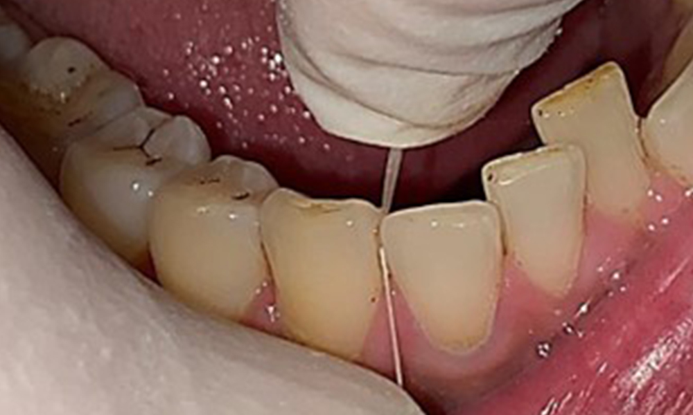 Use of dental floss. Use of dental floss.