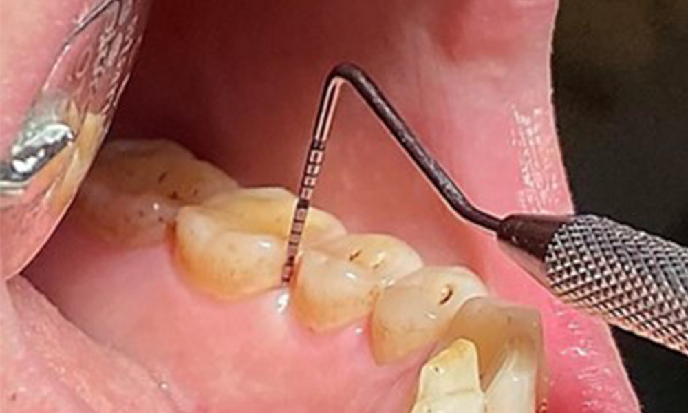 Pocket probing (BOP) with depiction of tooth 36 lingual Pocket probing (BOP) with depiction of tooth 36 lingual