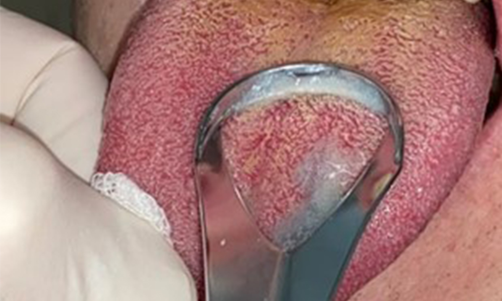 Tongue cleaning with a tongue scraper and tongue gel. Tongue cleaning with a tongue scraper and tongue gel.