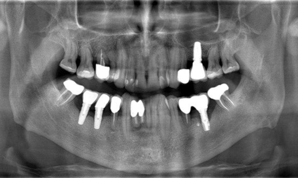 OPG: 26/02/2024 Dental X-ray: 18/01/2024 OPG: 26/02/2024 Dental X-ray: 18/01/2024