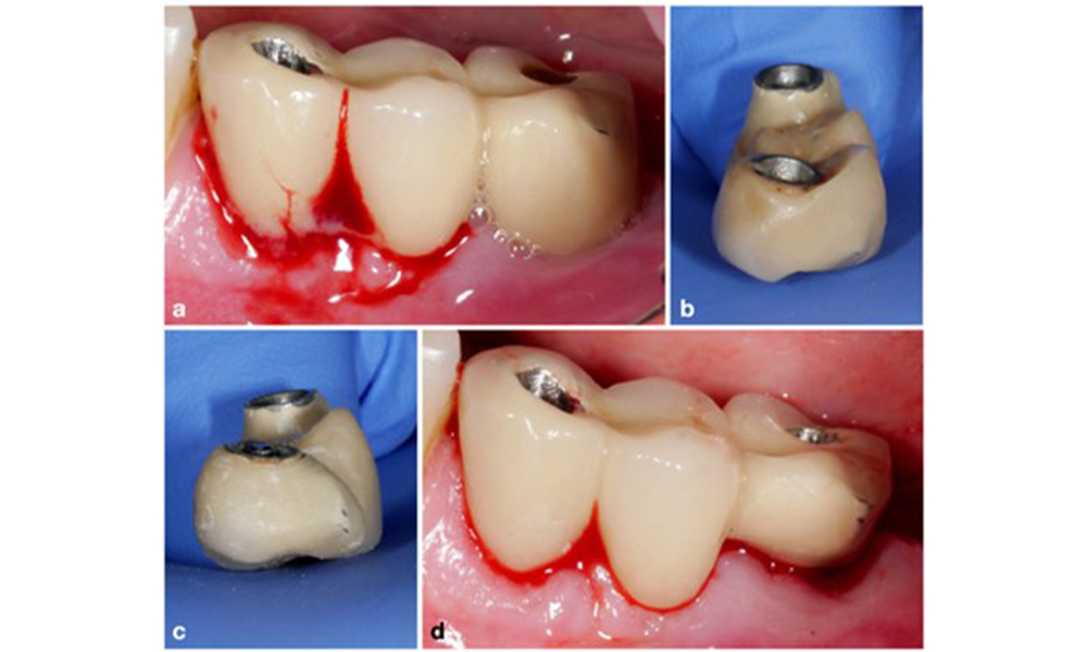 Modification of an existing bridge restoration. If the restoration hinders sufficient oral hygiene measures (notice the extreme overhang on the buccal aspect of the molar) (a–b), one of the first treatment steps should be adjusting the prosthetic design to enable effective cleaning (c–d). Modification of an existing bridge restoration. If the restoration hinders sufficient oral hygiene measures (notice the extreme overhang on the buccal aspect of the molar) (a–b), one of the first treatment steps should be adjusting the prosthetic design to enable effective cleaning (c–d).
