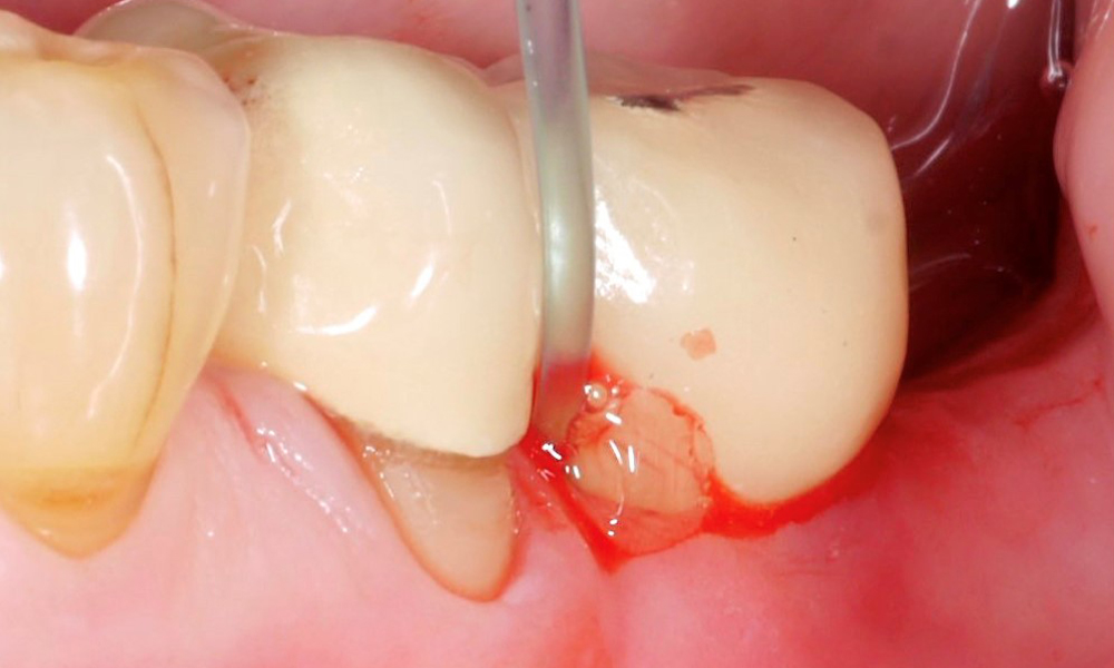 Nicht-chirurgische Periimplantitistherapie – chemische Reinigung ...? Nicht-chirurgische Periimplantitistherapie – chemische Reinigung ...?