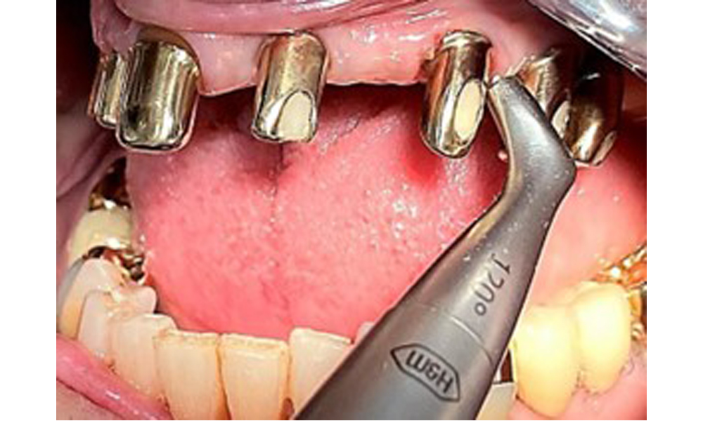 Air polishing (Proxeo Aura, W&H, shown here) of an implant. Air polishing (Proxeo Aura, W&H, shown here) of an implant.