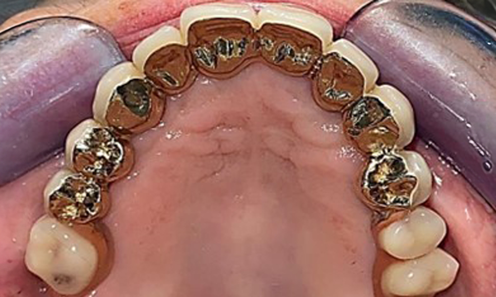 Occlusal view: Maxilla with removable, palateless denture. Occlusal view: Maxilla with removable, palateless denture.