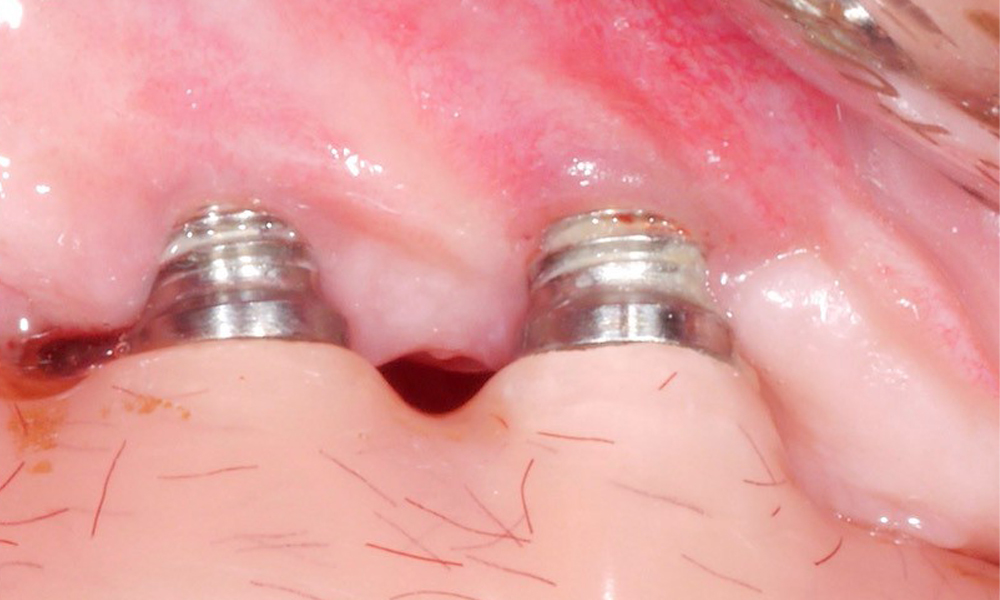 Keratinised soft tissue crucial for implants Keratinised soft tissue crucial for implants
