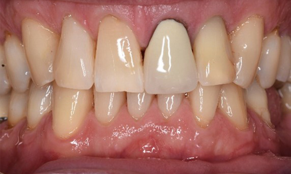 The (orally) healthy patient with implants The (orally) healthy patient with implants