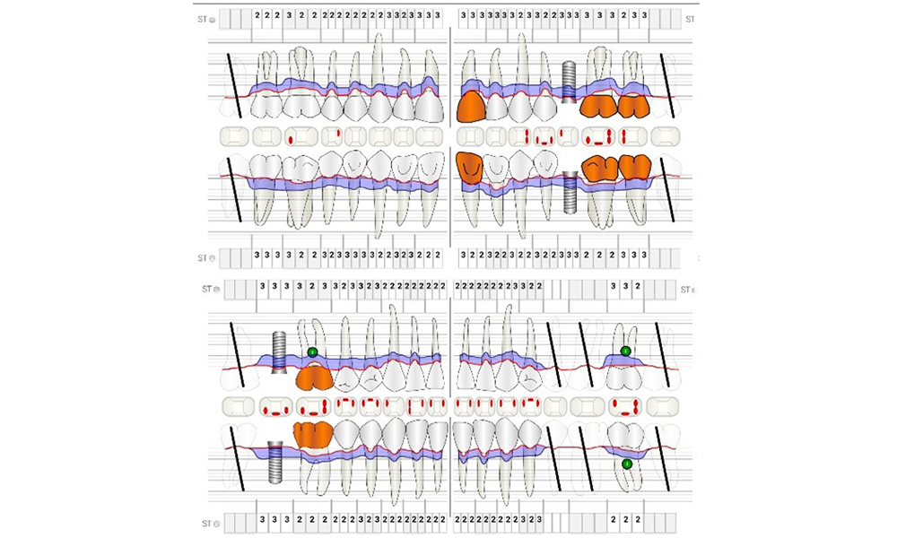 Periodontal status (ParoStatus®.de) Periodontal status (ParoStatus®.de)