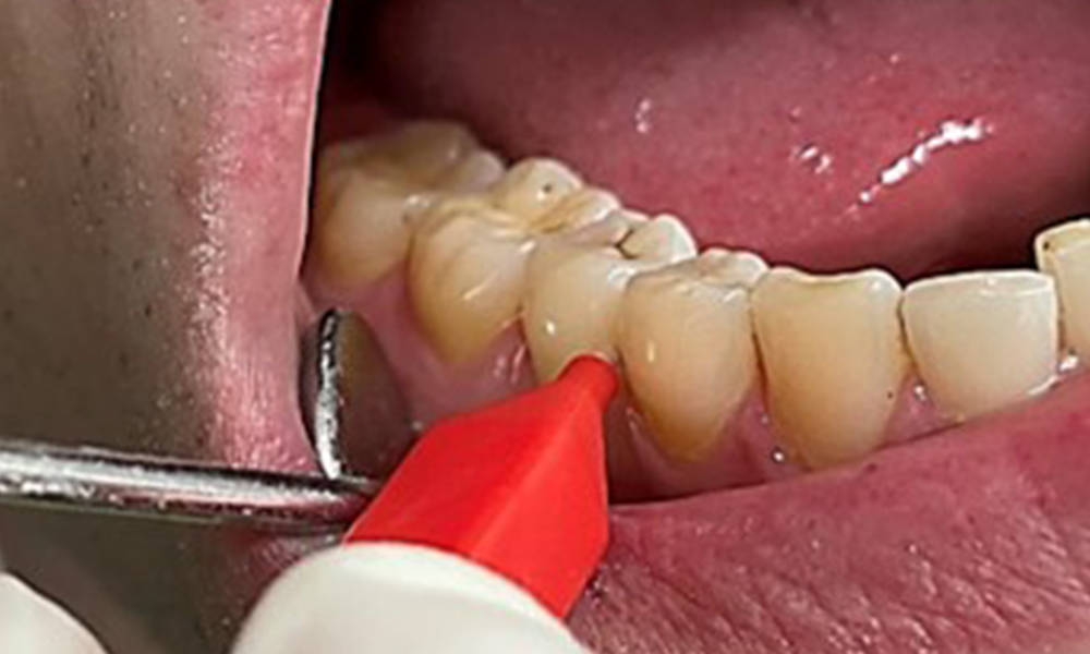 Use of the interdental brushes in the area near 44/45 Use of the interdental brushes in the area near 44/45