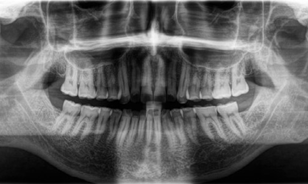 Panoramic X-ray image Panoramic X-ray image