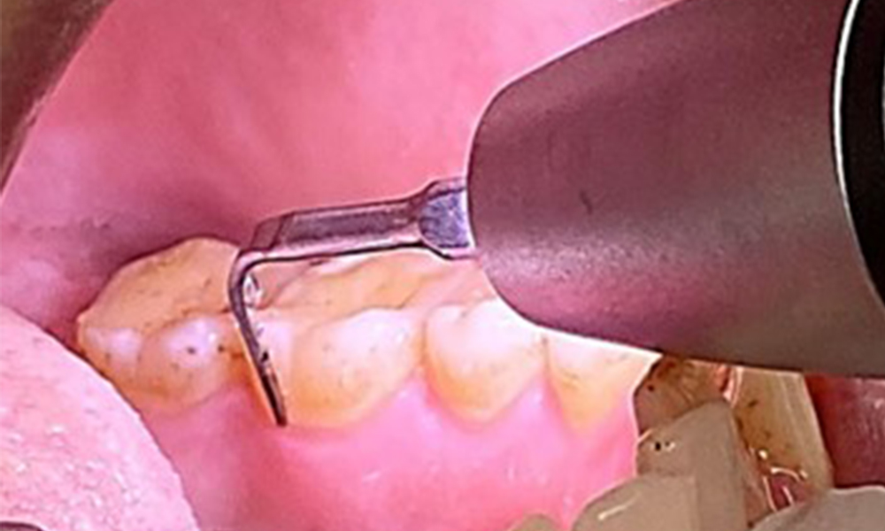 Use of a piezo-driven ultrasonic device in the lingual area near 36 (Proxeo Ultra, W&H, shown here) Use of a piezo-driven ultrasonic device in the lingual area near 36 (Proxeo Ultra, W&H, shown here)