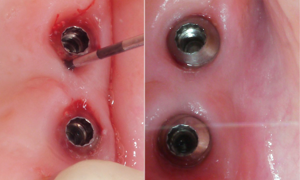 Patienten- und Implantatfaktoren – was beeinflusst das Therapieergebnis? Patienten- und Implantatfaktoren – was beeinflusst das Therapieergebnis?