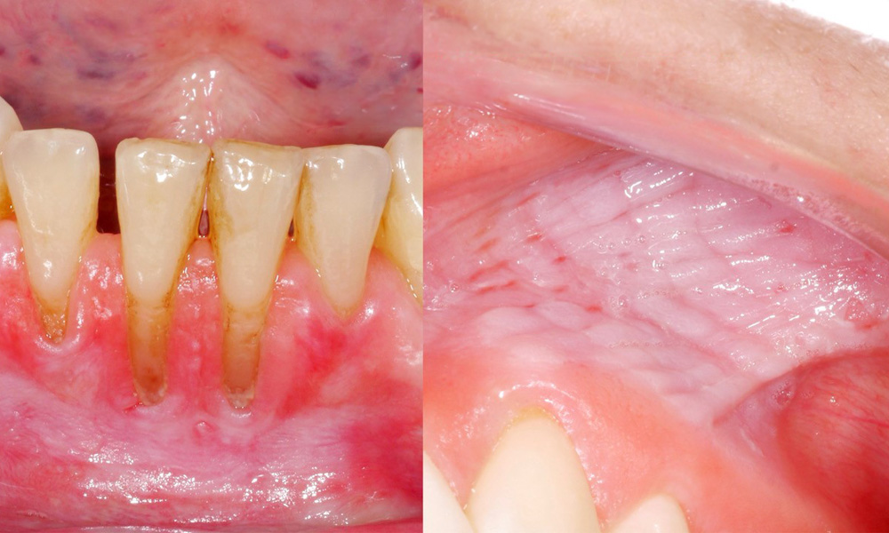 Snus causes mucosal lesions & gingival recession Snus causes mucosal lesions & gingival recession