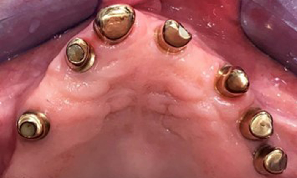 Okklusalansicht: Oberkiefer mit Zahn- und implantatgetragenen Teleskopen. Okklusalansicht: Oberkiefer mit Zahn- und implantatgetragenen Teleskopen.