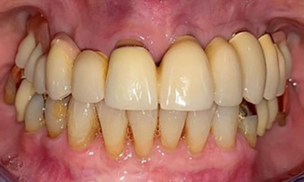 Frontal view with the maxillary denture in situ. Frontal view with the maxillary denture in situ.