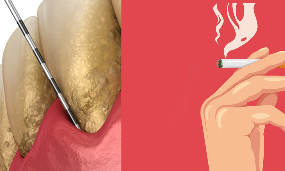 Smoking and increased probing depths are early warning signs Smoking and increased probing depths are early warning signs
