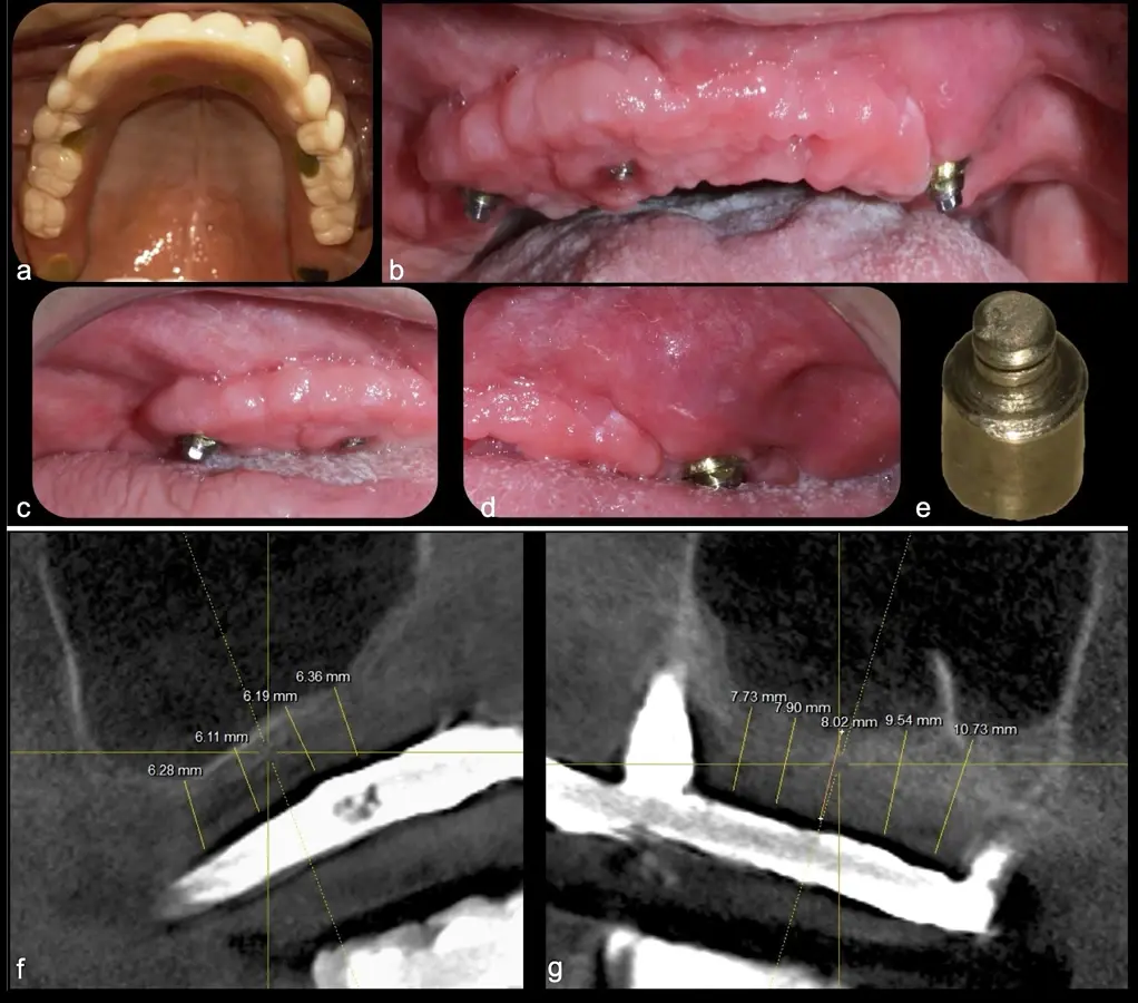 Evaluación intraoral en donde se evidencia presencia de una prótesis híbrida soportada sobre implantes dentales, al retiro de la estructura se observó tornillo protésico fracturado Evaluación intraoral en donde se evidencia presencia de una prótesis híbrida soportada sobre implantes dentales, al retiro de la estructura se observó tornillo protésico fracturado
