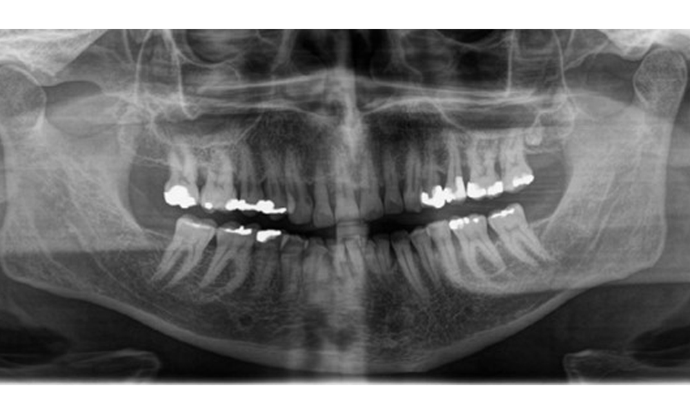 Panoramic X-ray image showing generalized radiological bone loss with multiple vertical defects of between 20% to 50%. Panoramic X-ray image showing generalized radiological bone loss with multiple vertical defects of between 20% to 50%.