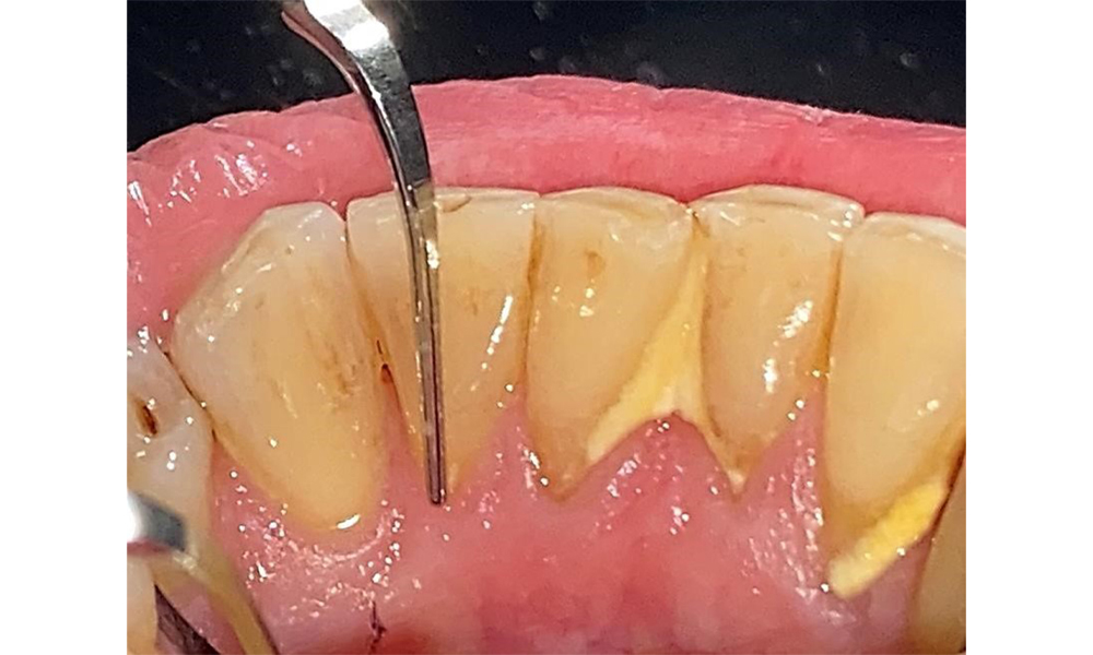 Use an ultrasonic tip to remove hard, mineralized plaque (Proxeo Ultra scaler with the Perio tip, W&H, shown here). Use an ultrasonic tip to remove hard, mineralized plaque (Proxeo Ultra scaler with the Perio tip, W&H, shown here).