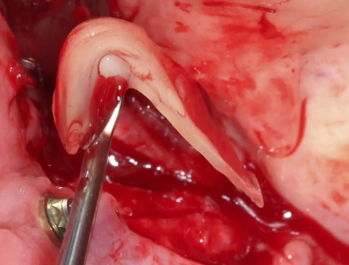 Colocación de membrana de PRF dentro del seno maxilar como protección de la membrana de Schneider. Colocación de membrana de PRF dentro del seno maxilar como protección de la membrana de Schneider.