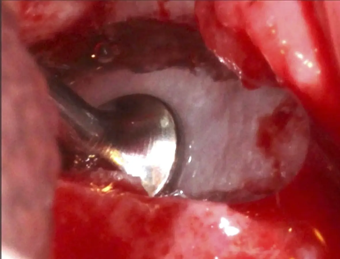 Introducción del bloque óseo de la pared lateral dentro del seno maxilar: inicio del desprendimiento de la membrana con el inserto de presión hidráulica Introducción del bloque óseo de la pared lateral dentro del seno maxilar: inicio del desprendimiento de la membrana con el inserto de presión hidráulica