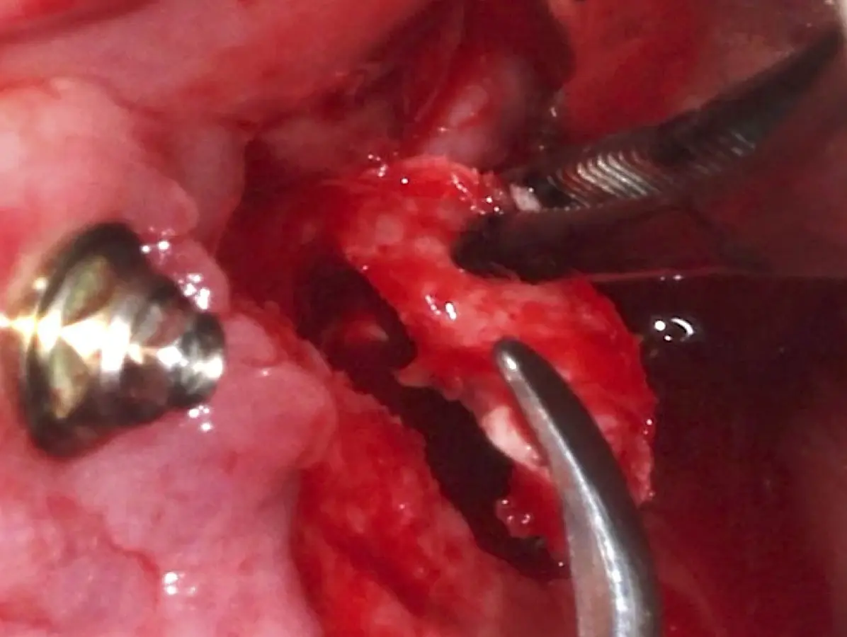 Reposicionamiento del bloque óseo de la pared lateral del seno maxilar Reposicionamiento del bloque óseo de la pared lateral del seno maxilar