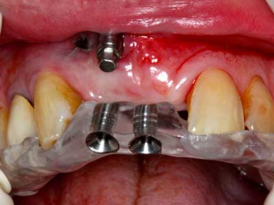 Piezosurgery Piezosurgery