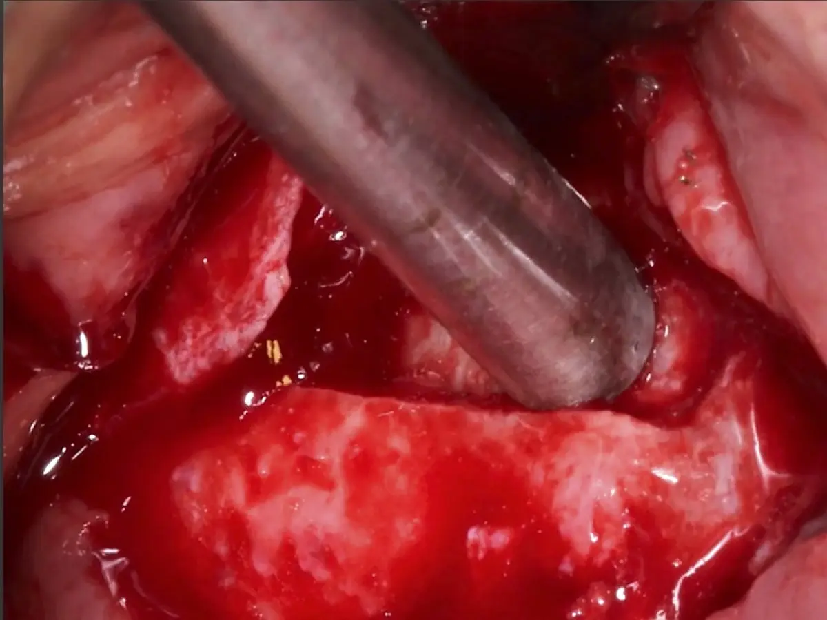 Fractura del bloque óseo con la ayuda de un martillo e instrumento romo. Fractura del bloque óseo con la ayuda de un martillo e instrumento romo.