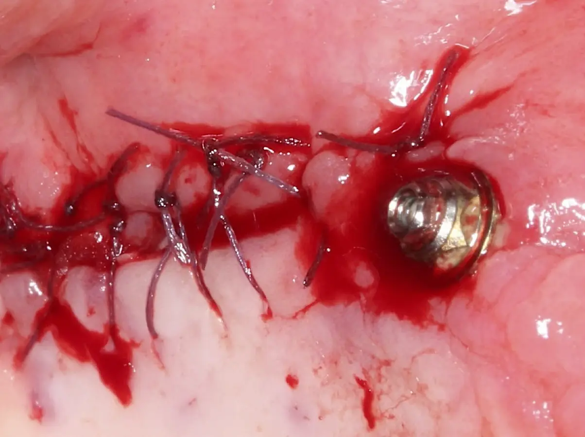 Liberación del colgajo, afrontamiento sin tensión y sutura. Liberación del colgajo, afrontamiento sin tensión y sutura.