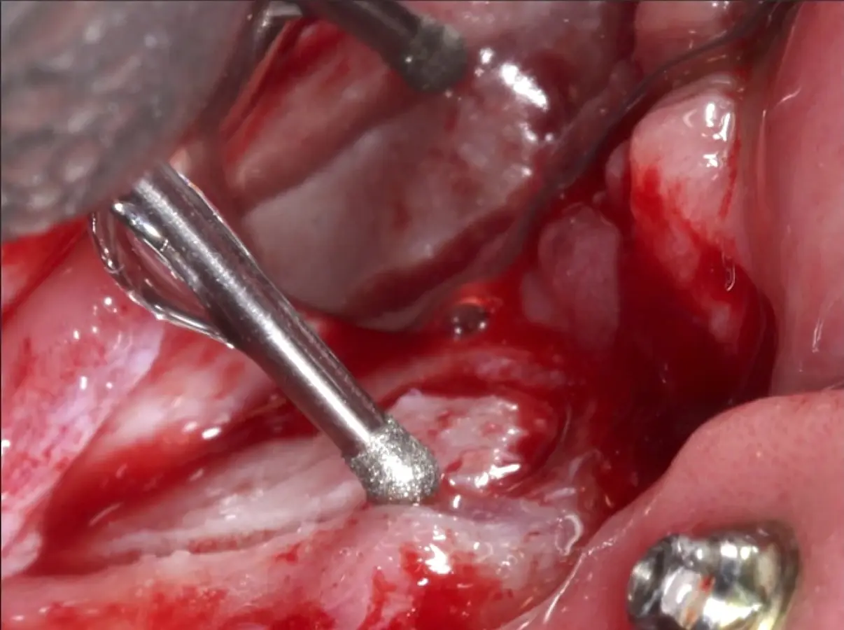 Delimitación y osteotomía por desgaste de la ventana lateral con el inserto redondo de punta diamantada Delimitación y osteotomía por desgaste de la ventana lateral con el inserto redondo de punta diamantada