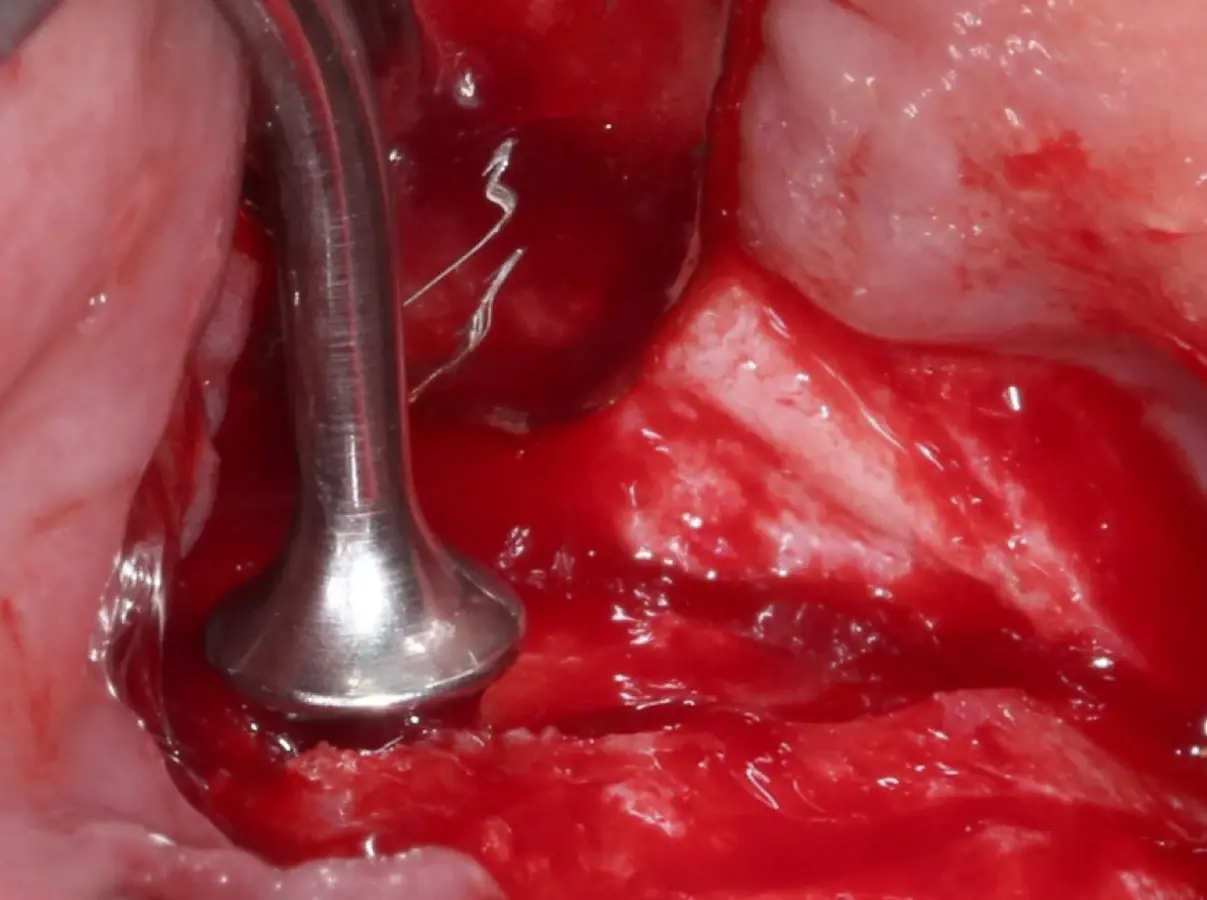 Inicio del desprendimiento de la membrana de Schneider con el inserto de presión hidráulica. Inicio del desprendimiento de la membrana de Schneider con el inserto de presión hidráulica.