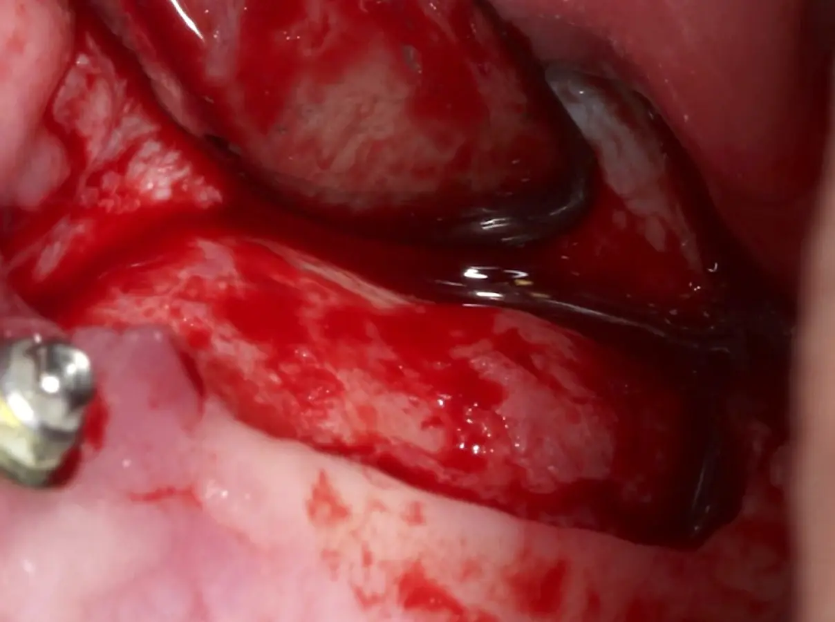 Incisión supracrestal y decolado a espesor total del lado izquierdo. Incisión supracrestal y decolado a espesor total del lado izquierdo.