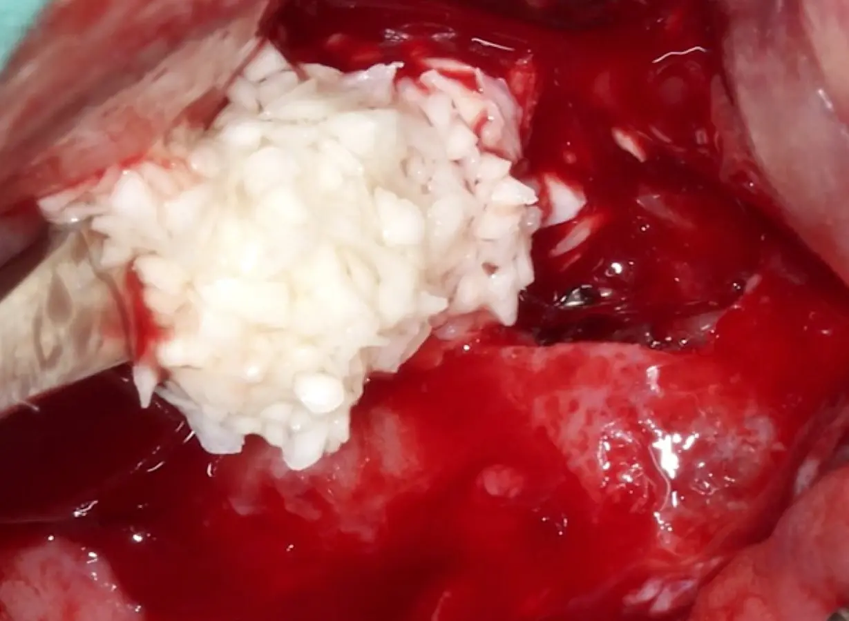 Llenado de la cavidad del seno maxilar con biomaterial de relleno óseo Llenado de la cavidad del seno maxilar con biomaterial de relleno óseo