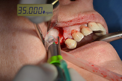 preparation of the nasal mucosa preparation of the nasal mucosa