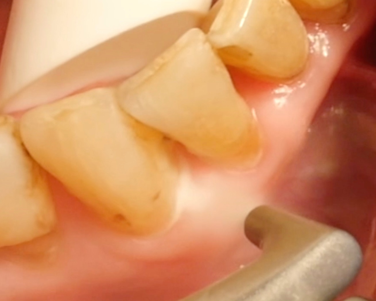 Air-polishing devices in periodontal treatment Air-polishing devices in periodontal treatment