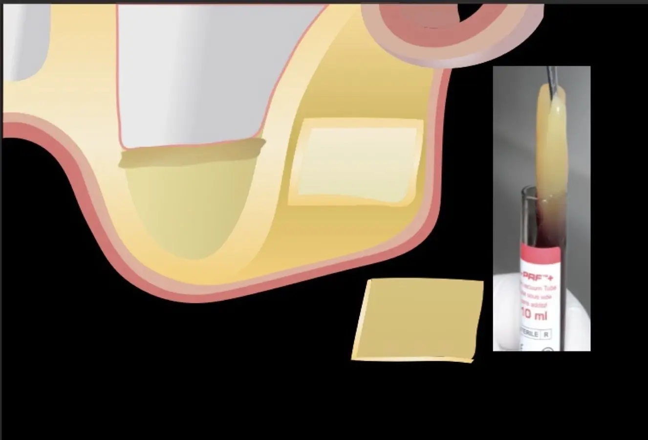 Membrana de PRF introducida dentro del seno maxilar. Membrana de PRF introducida dentro del seno maxilar.