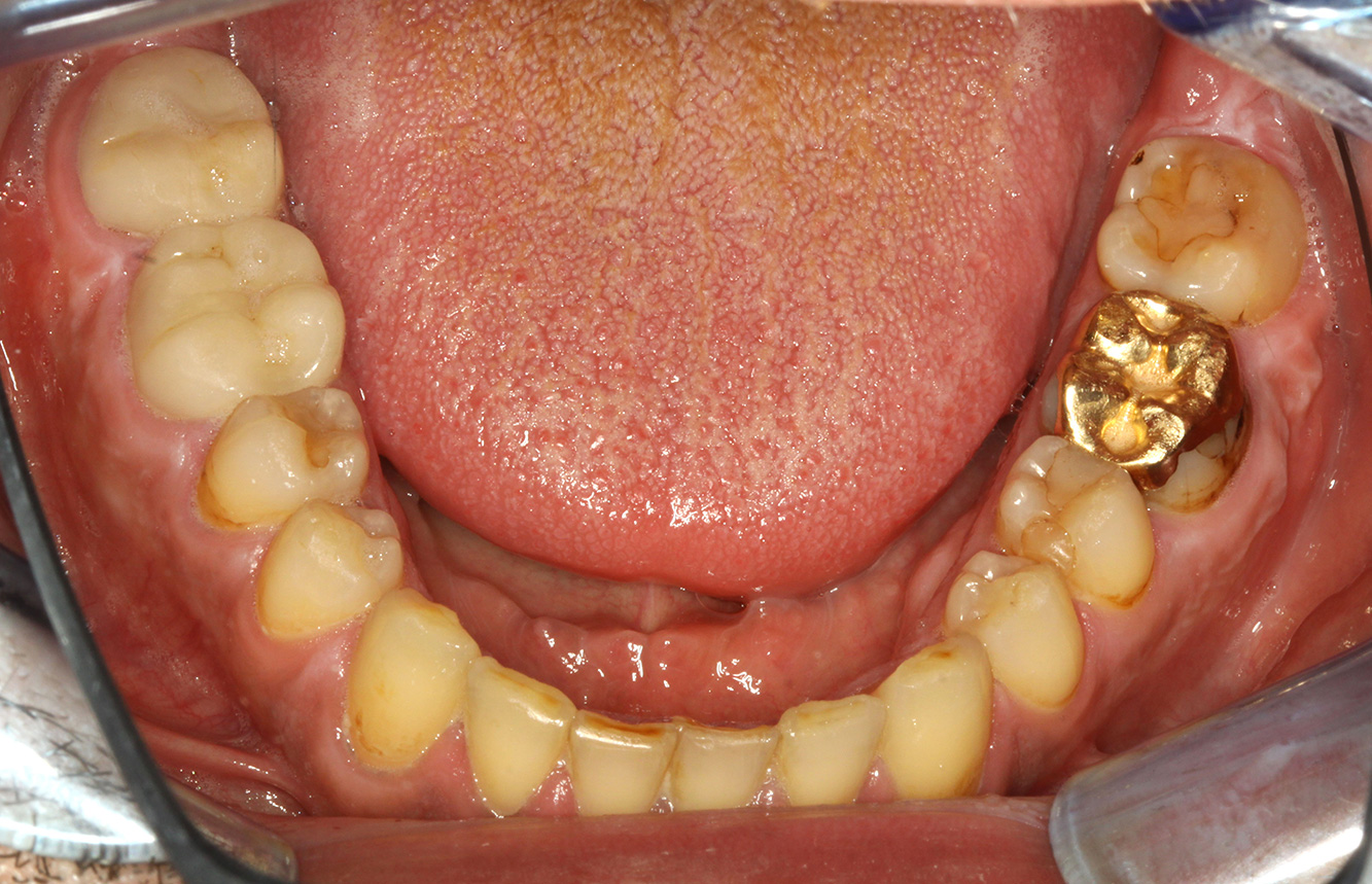 Paciente con endocarditis con lesiones de caries activas Paciente con endocarditis con lesiones de caries activas