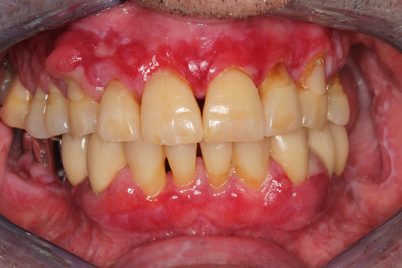 Paciente de trasplante con hiperplasia gingiva Paciente de trasplante con hiperplasia gingiva
