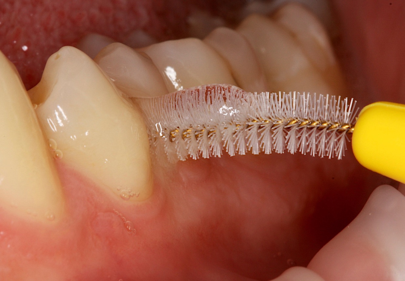 Interdental care – what is the best option?  Interdental care – what is the best option?