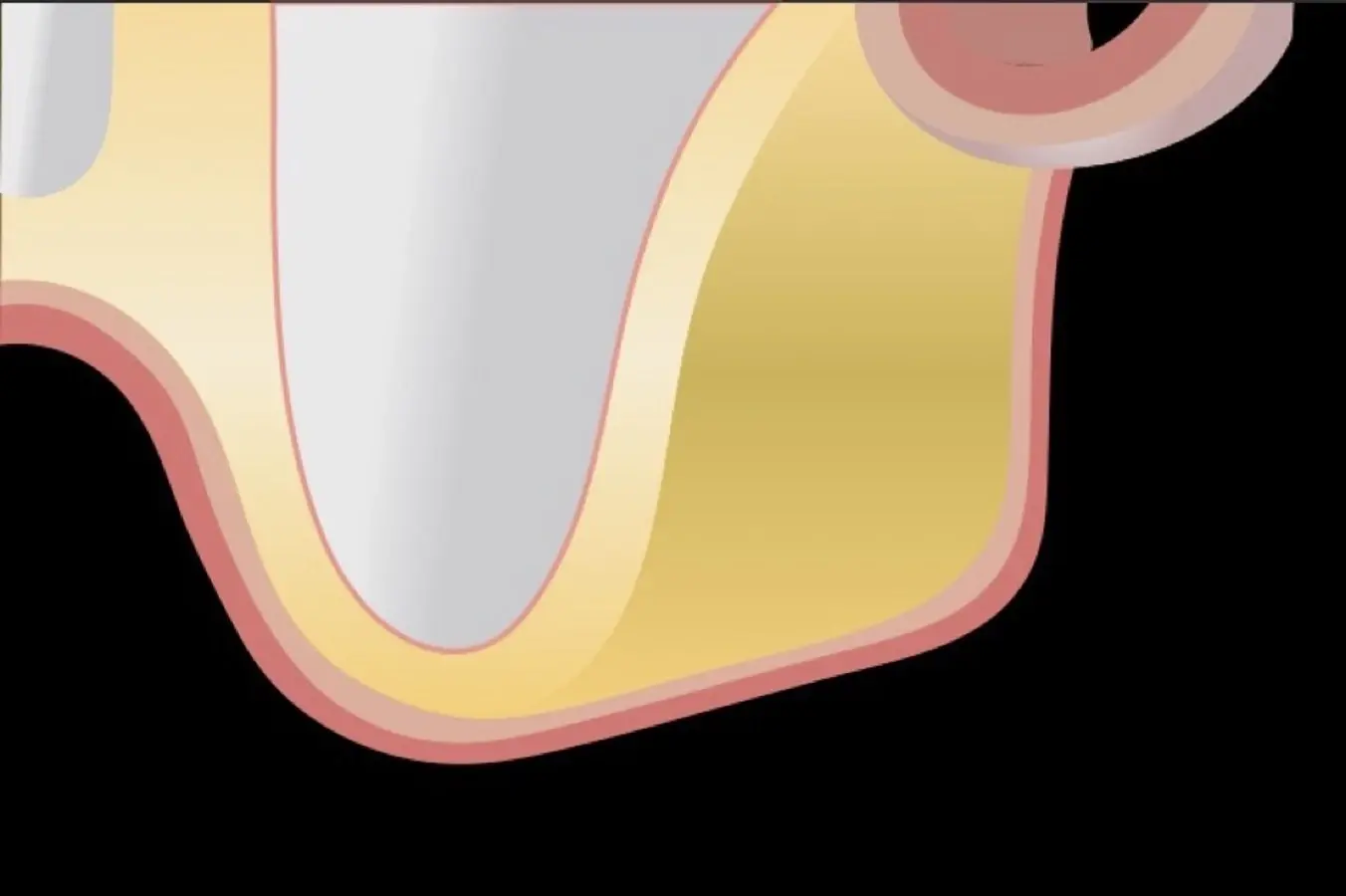 Incisión y levantamiento de colgajo a espesor total.  Incisión y levantamiento de colgajo a espesor total.