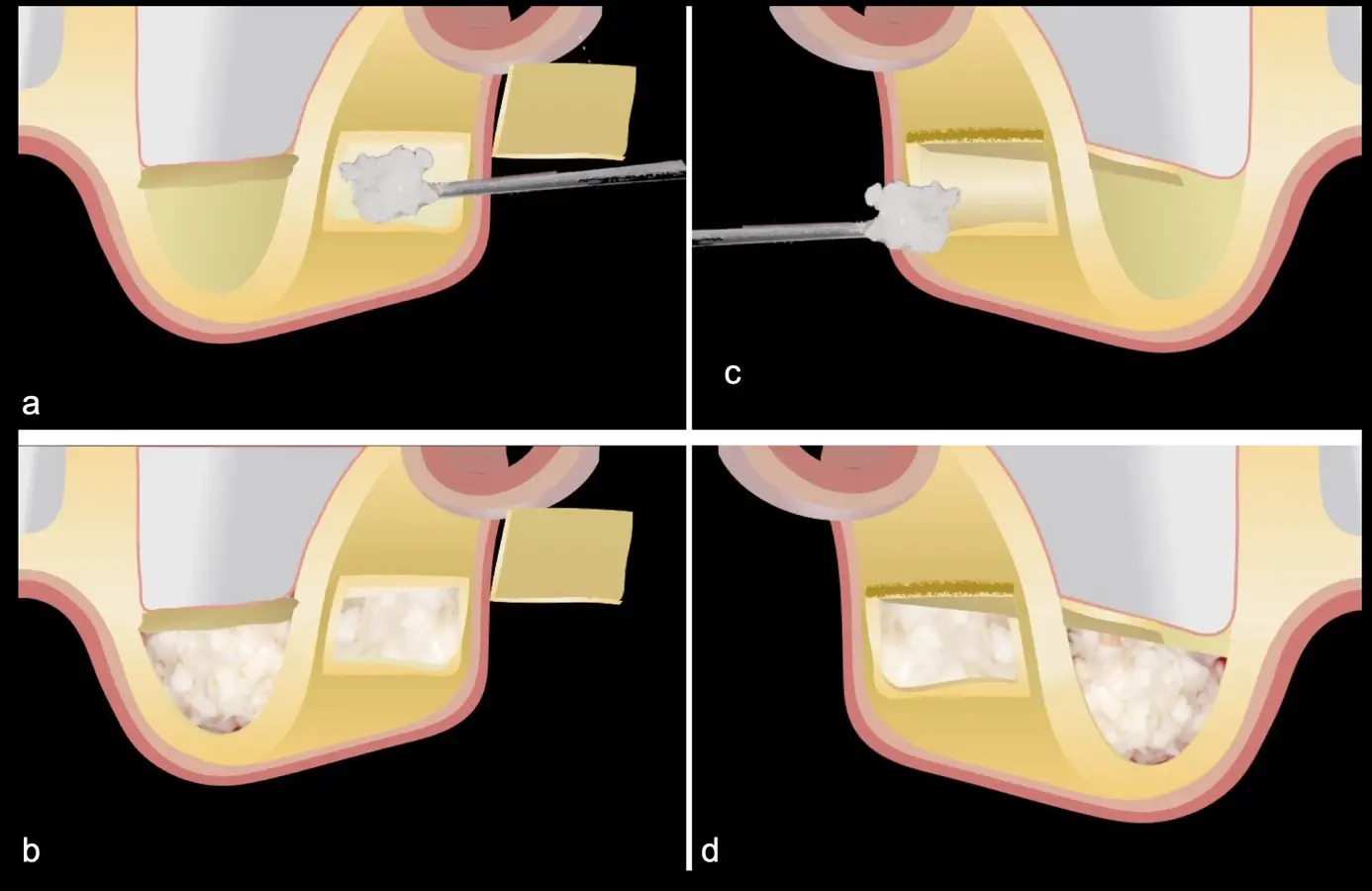 Introducción del sustituto óseo dentro del seno maxilar (a, b, c, d). Introducción del sustituto óseo dentro del seno maxilar (a, b, c, d).
