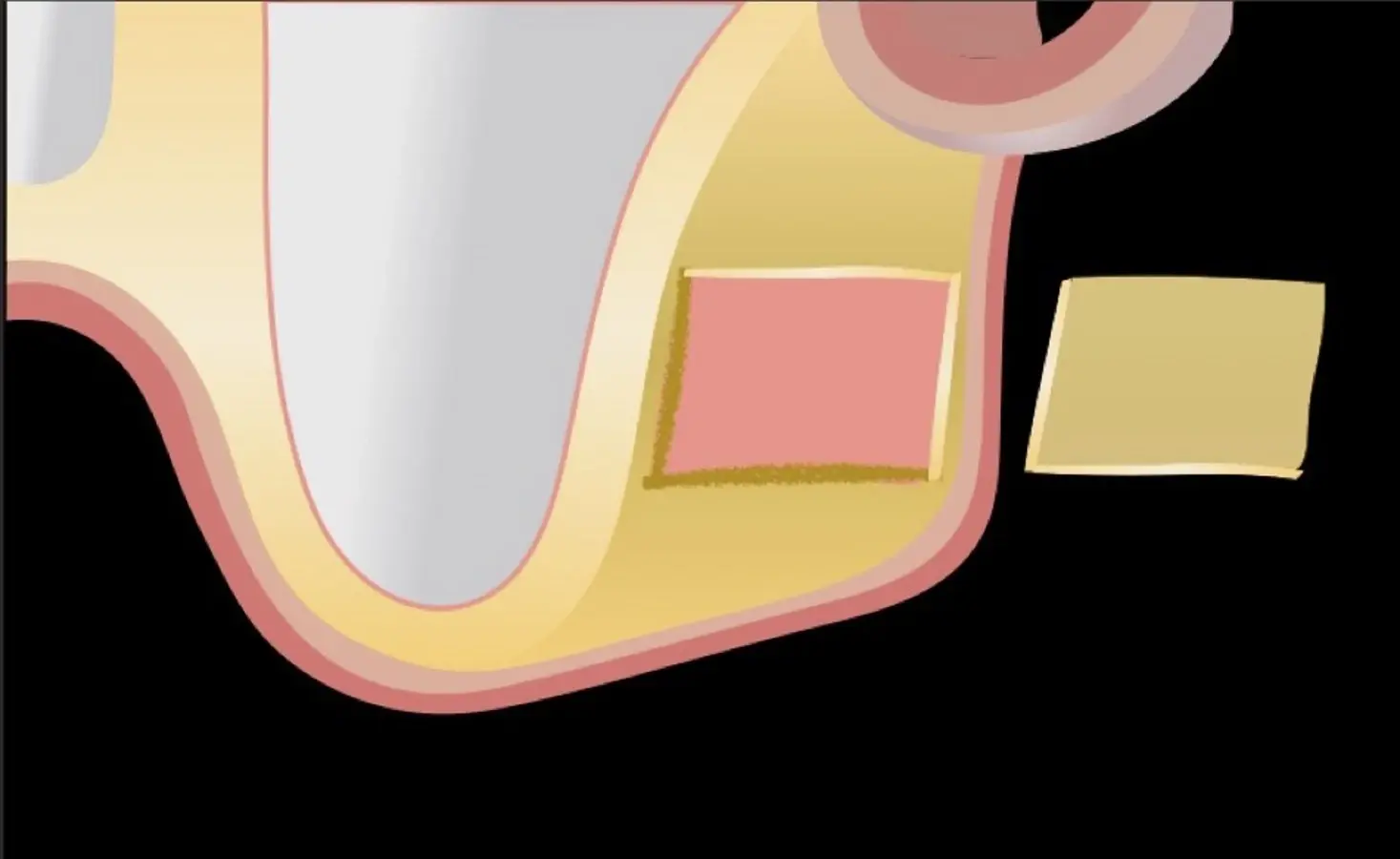 Técnica por introducción de la tabla ósea dentro del seno maxilar. Técnica por introducción de la tabla ósea dentro del seno maxilar.
