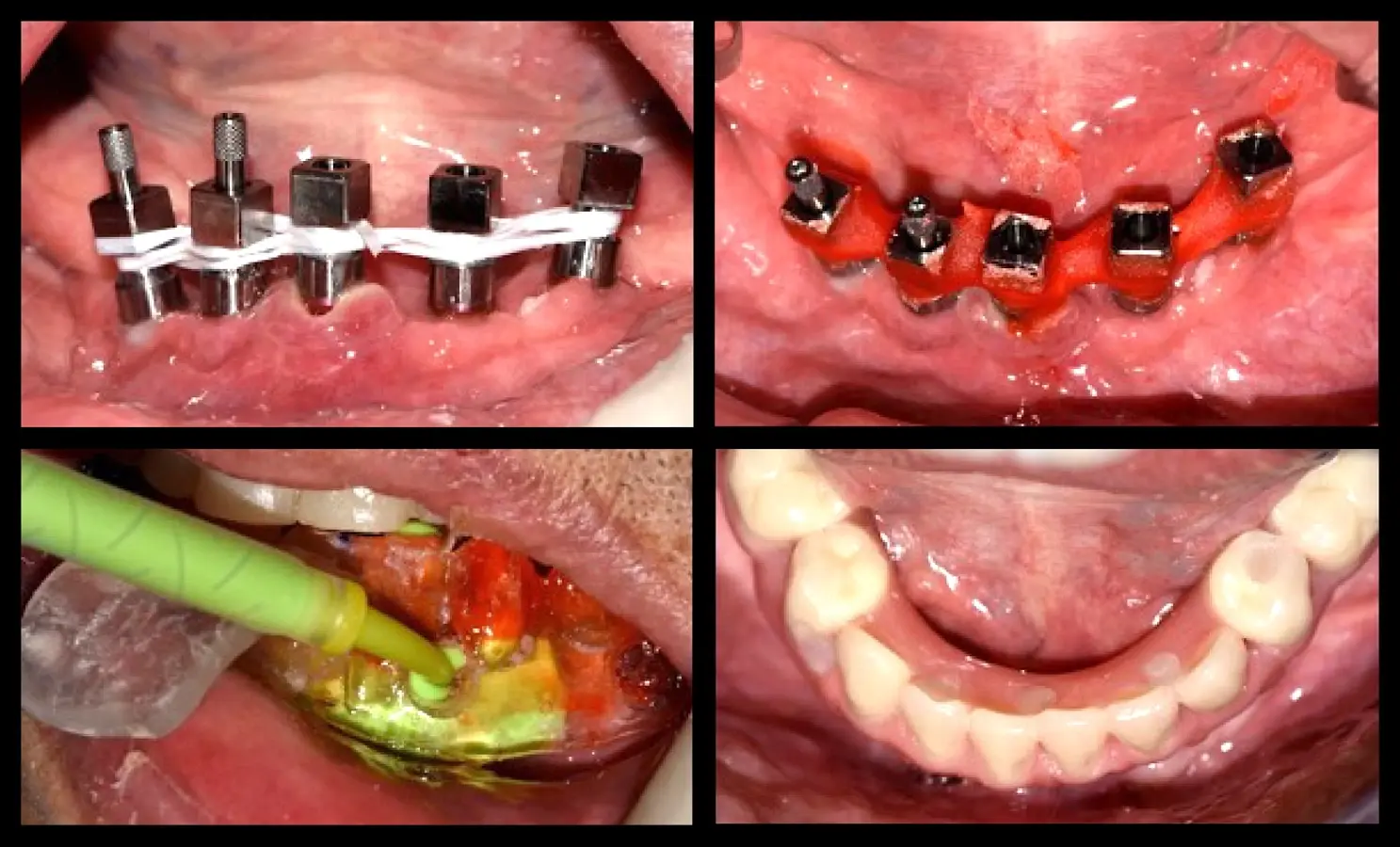 Rehabilitación fina Rehabilitación fina